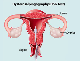 Hysterosalpingography: Get Infertility Treatment from Dr.Jasmine Kaur Dahyia-IVF, Infertility & Test Tube Baby Specialist