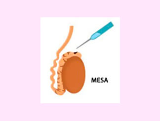 Micro-Surgical Epididymal Sperm Aspiration (MESA): Get Infertility Treatment from Dr.Jasmine Kaur Dahyia-IVF, Infertility & Test Tube Baby Specialist