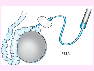 Percutaneous Epididymal Sperm Aspiration (PESA): Get Infertility Treatment from Dr.Jasmine Kaur Dahyia-IVF, Infertility & Test Tube Baby Specialist