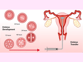 Tubal Embryo Transfer (TET): Get Infertility Treatment from Dr.Jasmine Kaur Dahyia-IVF, Infertility & Test Tube Baby Specialist